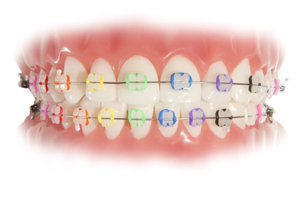braces color wheel abq orthodontics